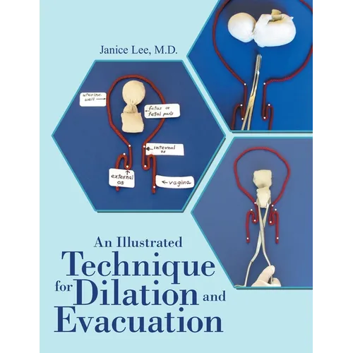 An Illustrated Technique for Dilation and Evacuation